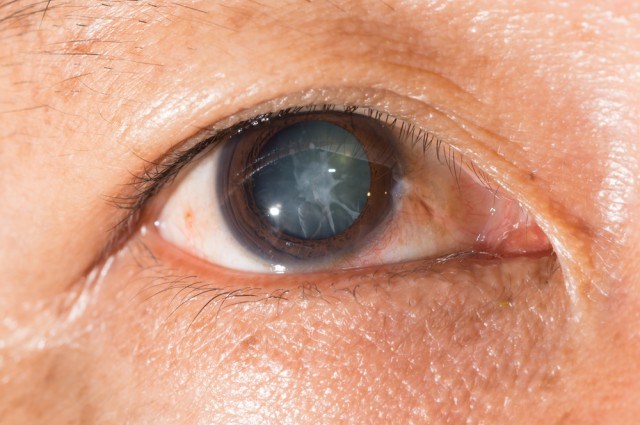 Cataractă glaucom vizual