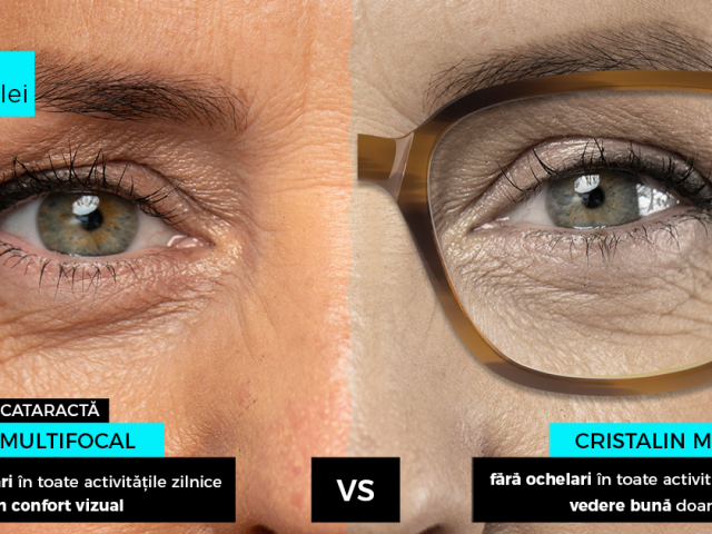 Cataracta a ambilor ochi istoric medical